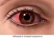 Red Eye