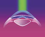 Lasik